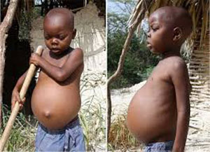 صورة: الكواشيوركور . . مرض البلدان الفقيرة