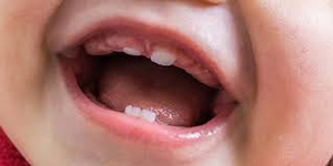 صورة: مراحل ظهور الأسنان عند الأطفال بالترتيب
