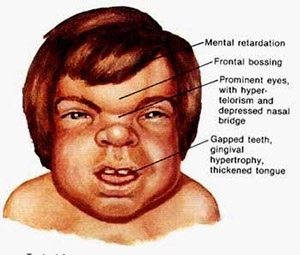 صورة: أسباب متلازمة هنتر لدى الأطفال