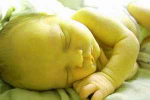 صورة: مرض الصفراء للأطفال حديثي الولاده ( تراكم البيليروبين )
