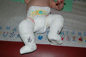 صورة: أسباب وعلاج القدم الحنفاء عند الأطفال