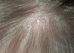 صورة: اسباب فطريات الشعر عند الاطفال وعلاجها وطرق الوقاية