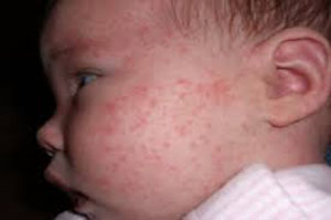 صورة: حساسية وجه و خدود الرضيع