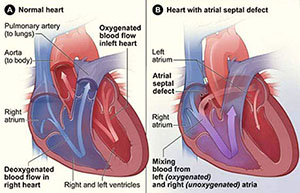 صورة: علاج ثقب القلب عند الاطفال