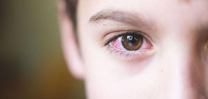 انسداد القناة الدمعية و فيديو انسداد مجرى الدمع عند الأطفال صورة: انسداد القناة الدمعية و فيديو انسداد مجرى الدمع عند الأطفال