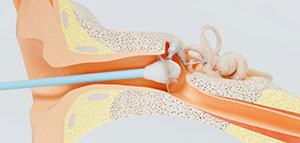 صورة: أعراض ثقب طبلة الأذن و مضاعفات ثقب طبلة الأذن