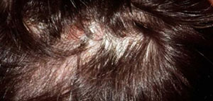 صورة: أجزاء الشعر ومكوناته و التهاب بصيلات الشعر