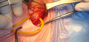 صورة: الفتق و عملية الفتق