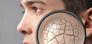 صورة: التشققات الجلدية و علاج التشققات الجلدية