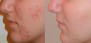 صورة: حب الشباب و وصفات لإزالة حب الشباب وآثاره عن البشرة