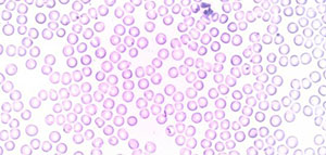 ارتفاع عدد كريات الدم البيضاء و أسباب ارتفاع عدد كريات الدم البيضاء صورة: ارتفاع عدد كريات الدم البيضاء و أسباب ارتفاع عدد كريات الدم البيضاء