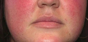 احمرار الوجه وسخونته و أسباب احمرار الوجه وسخونته صورة: احمرار الوجه وسخونته و أسباب احمرار الوجه وسخونته