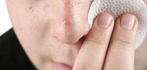 الرؤوس السوداء و طرق طبية لإزالة الرؤوس السوداء صورة: الرؤوس السوداء و طرق طبية لإزالة الرؤوس السوداء