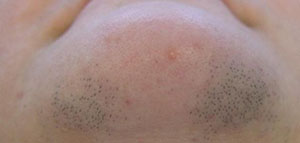 شعر الوجه و خلطات طبيعية لإزالة شعر الوجه صورة: شعر الوجه و خلطات طبيعية لإزالة شعر الوجه