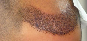 صورة: زراعة الشعر