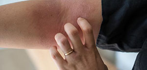 صورة: أعراض التحسس من الأدوية و أعراض تستدعي التدخل الطبي