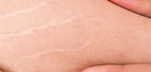 تشققات البطن بعد الولادة و وصفات لإزالة تشققات البطن بعد الولادة صورة: تشققات البطن بعد الولادة و وصفات لإزالة تشققات البطن بعد الولادة