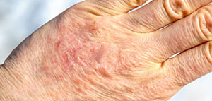 صورة: أسباب تجعد اليدين و علاج تجاعيد اليدين بالموز