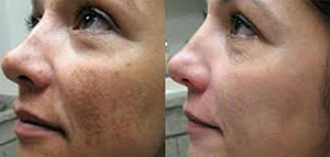 صورة: الكلف و أسباب الكلف و وصفات طبيعية لإزالة الكلف