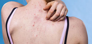 حبوب الظهر وآثارها و التخلص من آثار الحبوب في الظهر صورة: حبوب الظهر وآثارها و التخلص من آثار الحبوب في الظهر