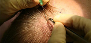 صورة: زراعة الشعر و مراحل زراعة الشعر و أسباب تساقط الشعر عند النساء