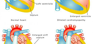 صورة: دعامات القلب و رأب الأوعية الدموية و مخاطر عملية رأب الأوعية الدموية