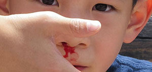 صورة: علاج نزيف الأنف عند الأطفال و أسباب نزيف الأنف عند الأطفال