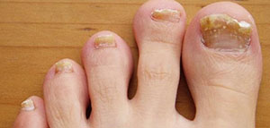 صورة: صودا الخبز و زيت شجرة الشاي و زيت الزيتون