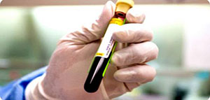 صورة: تحليل CBC و ماذا يقيس تحليل CBC و الحالات التي تستدعي إجراء تحليل CBC