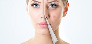 صورة: هل يمكن التخلص من حب الشباب دون أدوية و إجراءات طبية للتخلص من حب الشباب