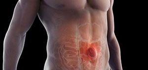 صورة: أسباب الفتق الإربي و الوقاية من الفتق الإربي