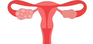 صورة: أعراض تكيس المبايض و هل يؤثر تكيس المبايض على الحمل