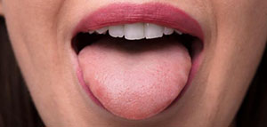 صورة: خدر اللسان و من أسباب الإصابة بخدر اللسان