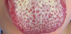 صورة: ما هي فطريات اللسان و أعراض فطريات اللسان