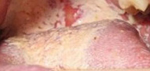 صورة: ما أسباب فطريات الفم و عوامل خطر الإصابة بفطريات الفم