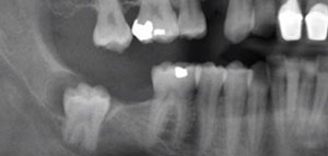 صورة: ضرس العقل و أسباب عدم ظهور أضراس العقل
