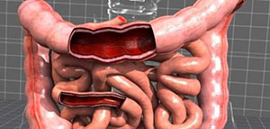 صورة: القولون العصبي و أكل مريض القولون و فيديو أفضل الأطعمة لمريض القولون