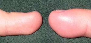 صورة: انتفاخ الجسم و ظهور تورمات في الجسم و فيديو أسباب انتفاخ الجسم