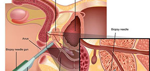 علاج البروستاتا و الوقاية و فيديو عن تضخم البروستات وعلاجه صورة: علاج البروستاتا و الوقاية و فيديو عن تضخم البروستات وعلاجه