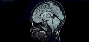 ماذا يعني ضمور المخيخ عند الأطفال و ما هي أسباب الإصابة بضمور المخيخ عند الأطفال صورة: ماذا يعني ضمور المخيخ عند الأطفال و ما هي أسباب الإصابة بضمور المخيخ عند الأطفال
