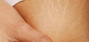 صورة: تشققات الجسم و علاجات منزلية للتخلص من تشققات الجسم