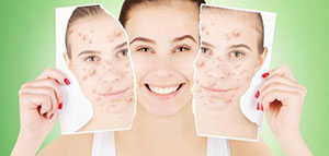 تبييض البشرة الدهنية و أقنعة لتبييض البشرة الدهنية صورة: تبييض البشرة الدهنية و أقنعة لتبييض البشرة الدهنية