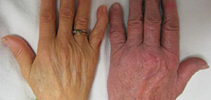 صورة: فقر الدم