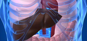 صورة: علاج غيبوبة الكبد و نصائح وإرشادات لمرضى غيبوبة الكبد