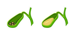 أسباب تكون حصوات المرارة و عوامل خطر حصوات المرارة صورة: أسباب تكون حصوات المرارة و عوامل خطر حصوات المرارة