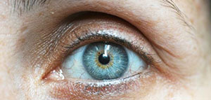 صورة: الطرق الطبية لعلاج الهالات السوداء نهائيا