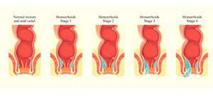 أنواع البواسير و أسباب البواسير و الوقاية من البواسير صورة: أنواع البواسير و أسباب البواسير و الوقاية من البواسير