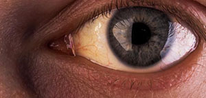 صورة: أسباب اليرقان عند الرضع و أسباب اليرقان عند البالغين