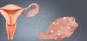 صورة: السمنة ومتلازمة تكيس المبايض و نصائح وعلاجات الوزن الزائد
