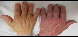 كيف أعرف أنني أعاني من فقر الدم و كيف يتم تشخيص فقر الدم بشكل مؤكد صورة: كيف أعرف أنني أعاني من فقر الدم و كيف يتم تشخيص فقر الدم بشكل مؤكد